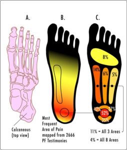 PF-PainAreas plantar fasciitic pain areas