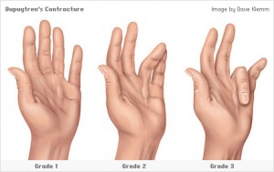 dupuytren_contracture